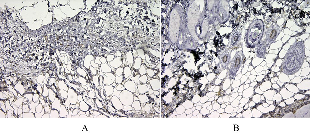 Figure 5. 3 days after implantation. We have noted moderate expression of CD68+ in the first group of animals (A). There is pronounced expression of the macrophage marker CD68 in the second group after autodermal implantation (B). X100.