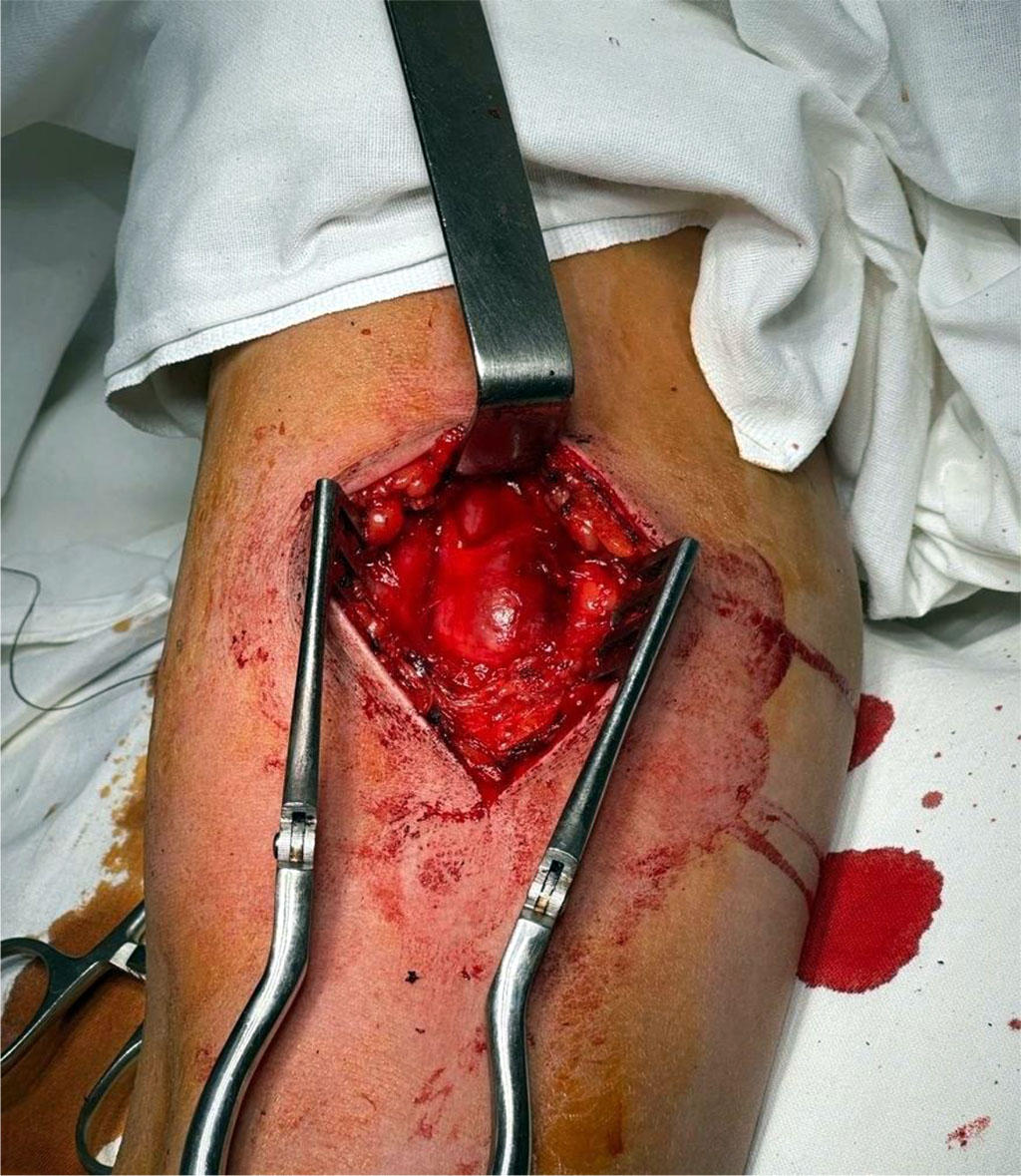 Figure 1. Access to the pseudoaneurysm is provided.