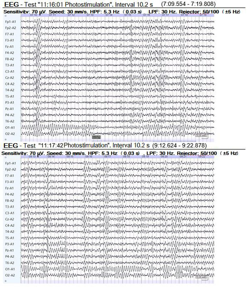Figure 1. EEG of a patient with 85% stenosis of the right external carotid artery and 90% of the internal carotid artery 