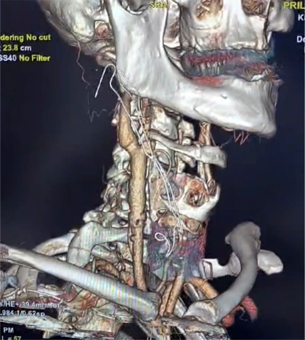 Figure 3. CT angiography (3D reconstruction) 2 weeks after surgery. The carotid segment is completely patent.