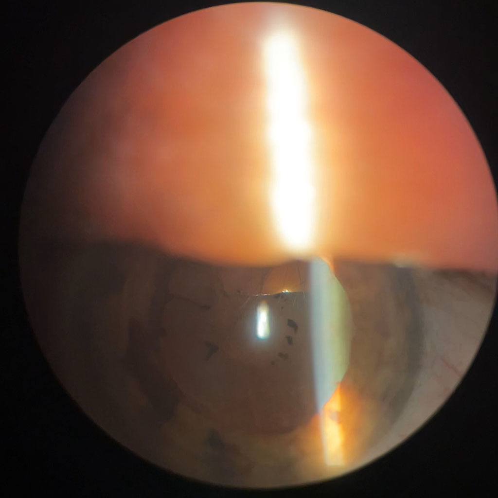 Figure 2. Released posterior synechiae in a patient with acute anterior uveitis