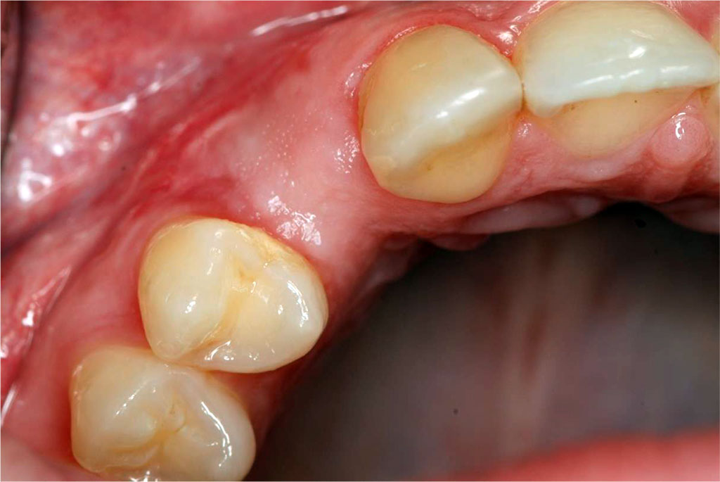 Fig.1 The condition of the peri-implant soft tissues before sCTG augmentation.