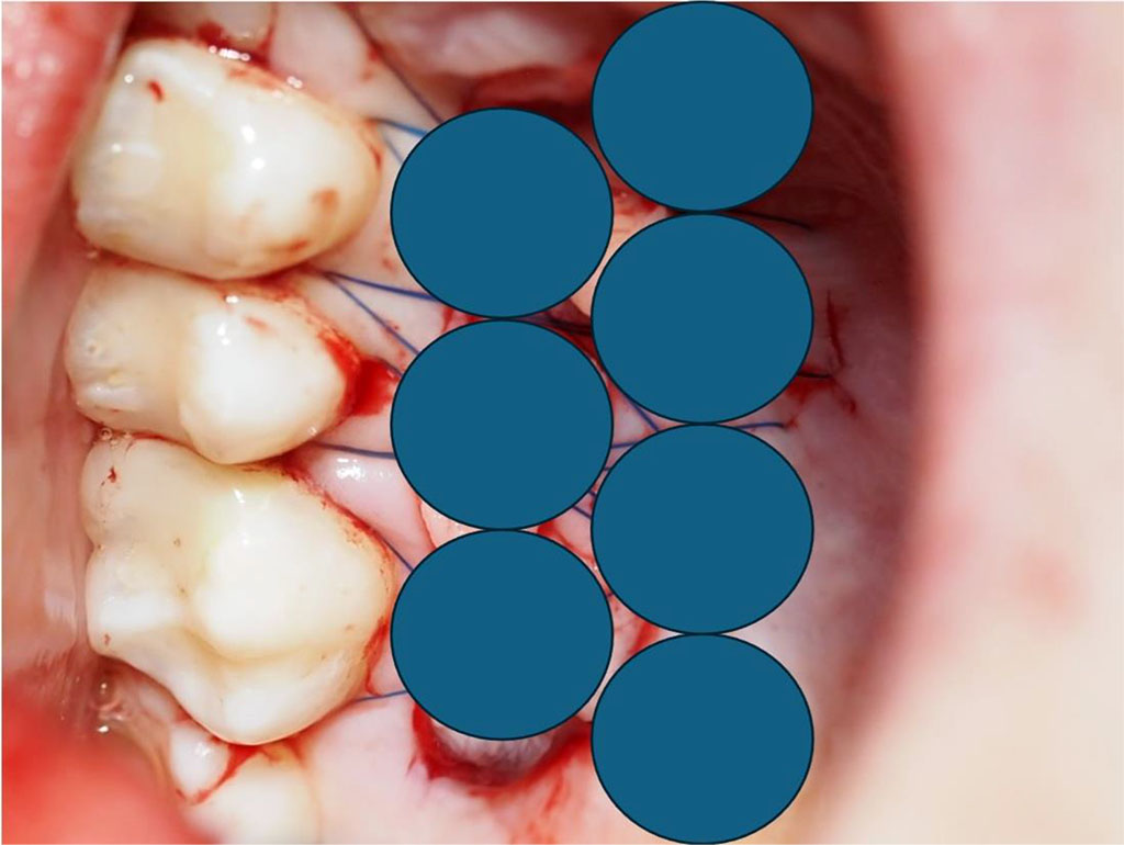 Fig.11 Diagram showing 7 intraoral points of non-contact irradiation of the donor site.