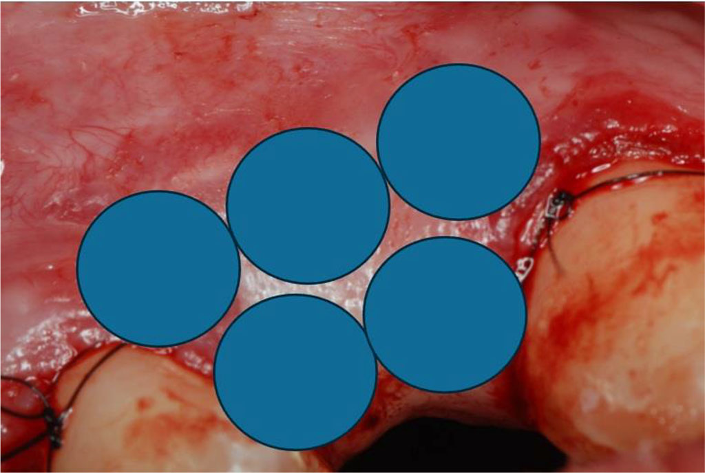 Fig.12 Diagram showing 5 intraoral points of non-contact irradiation of the recipient site.