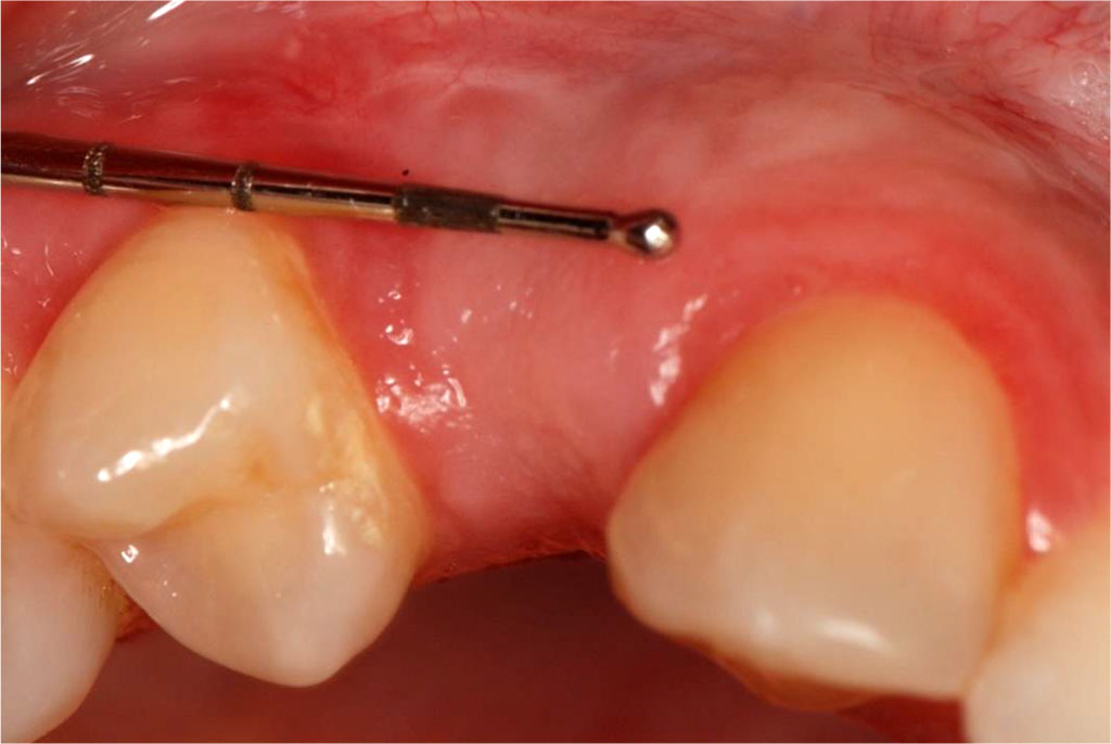 Fig.13 Tissue condition one month after the surgical procedure.