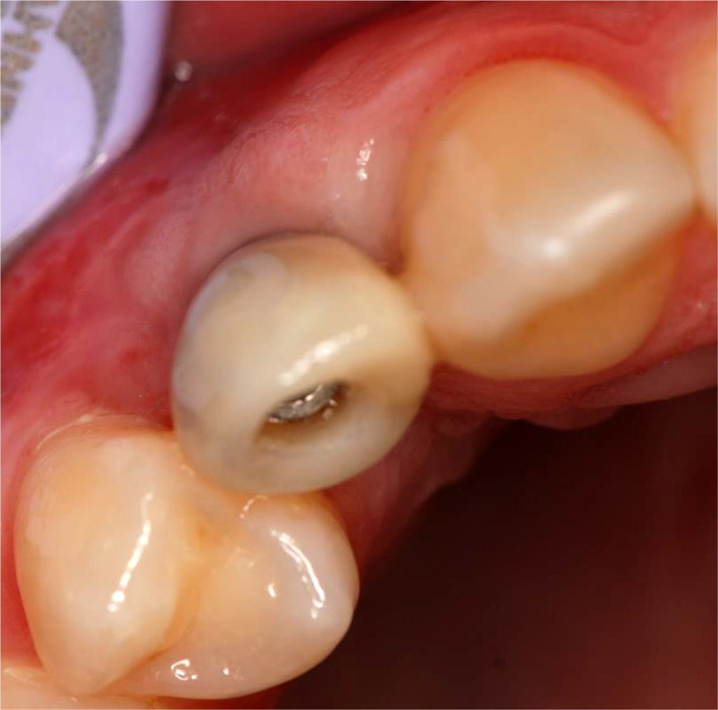 Fig.14 Tissue condition after augmentation procedures with a temporary crown in place (occlusal view).