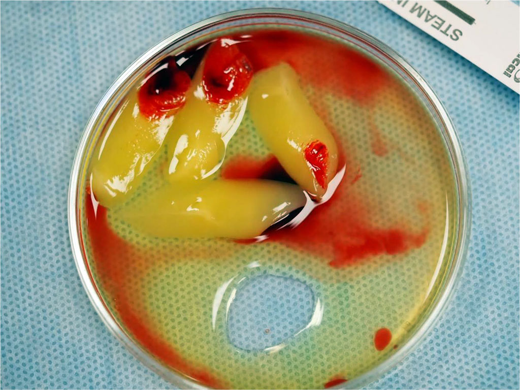 Fig.2 Before the procedure, blood was drawn from the patient's antecubital vein and then centrifuged to obtain advanced platelet-rich fibrin (A-PRF) membranes, which were used to protect the donor site on the palate.