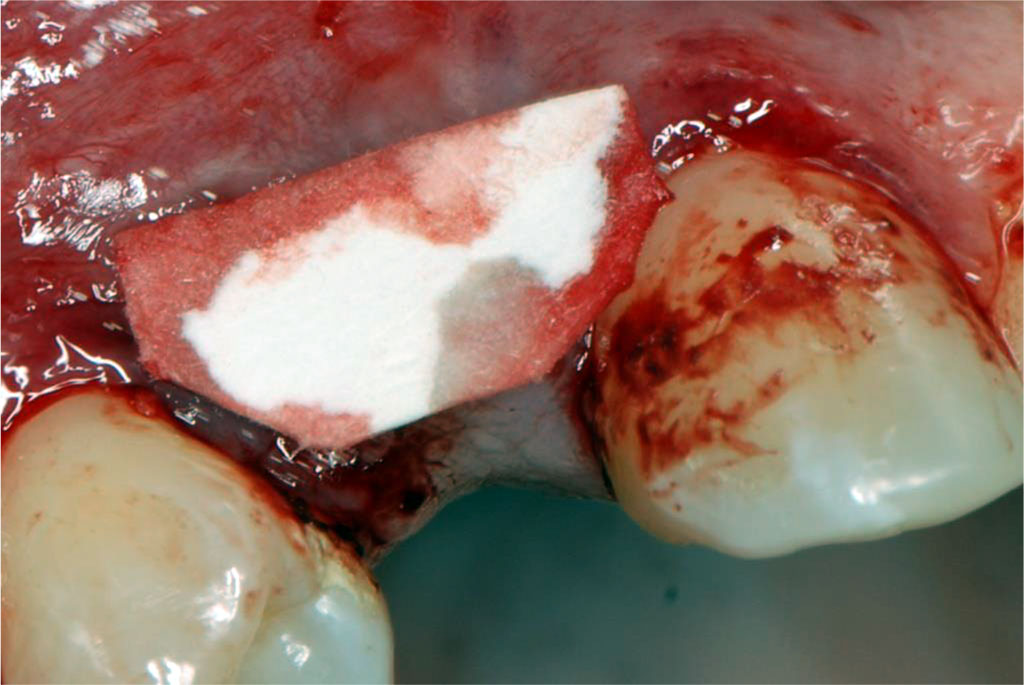 Fig.3 The template size was determined based on the recipient site to accurately harvest the required amount of tissue from the donor site.