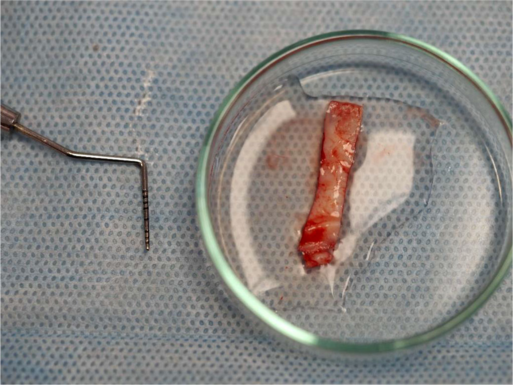 Fig.5 The epithelial-connective tissue graft was de-epithelialized after harvesting, resulting in an sCTG.