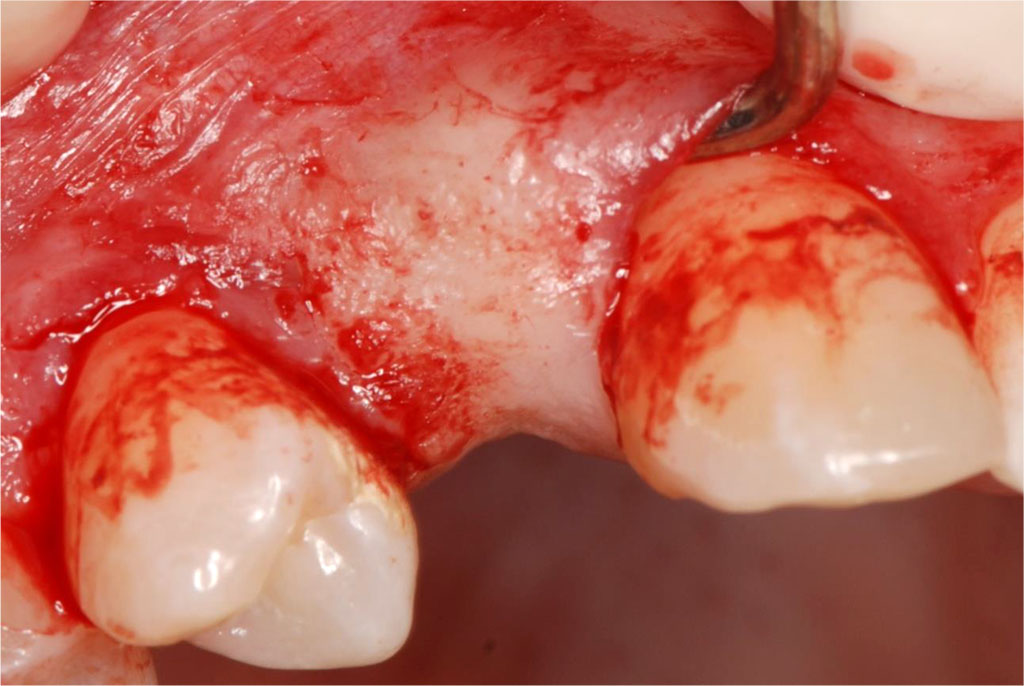 Fig.7 Tunnel preparation in the area of 12-14 using a tunneling instrument set. (Helmut Zepf Medizintechnik GmbH, Seitingen-Oberflacht, Germany).