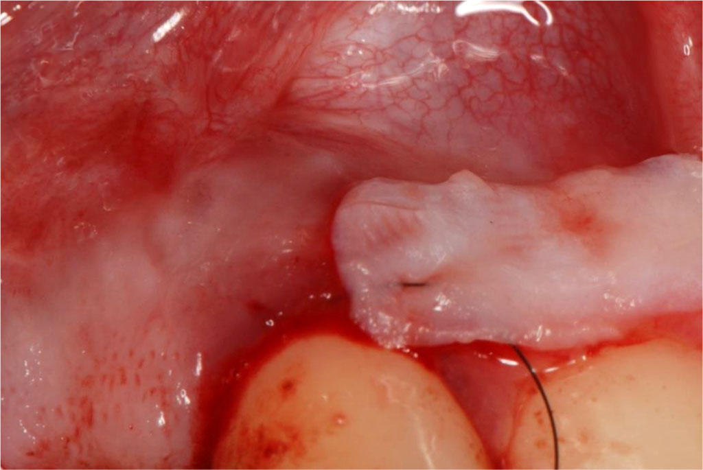 Fig.8 Insertion of the sCTG into the prepared tunnel.