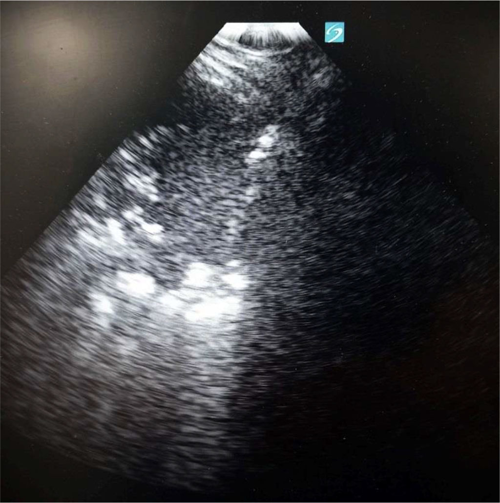 Figure 2. Consolidation with air bronchogram at the left side, diaphragm in the middle and liver at the right side. Author’s private materials.