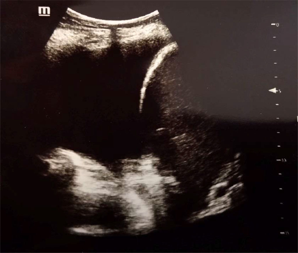 Figure 3. Pleural effusion (anechoic), diaphragm and liver at the right side. Author’s private materials.