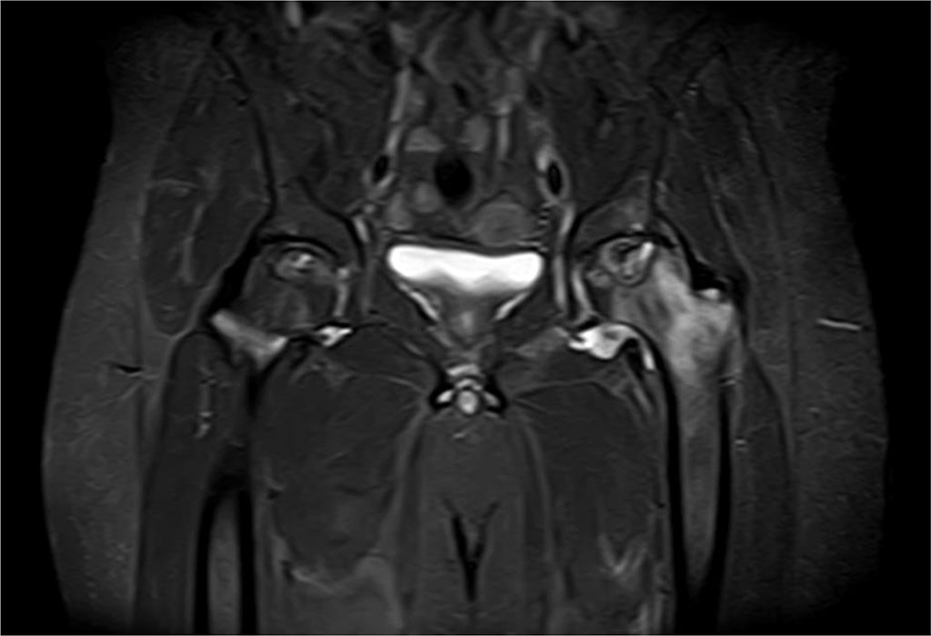 Figure 3. Findings in a 50-year-old male patient with stage 3 avascular necrosis of the left