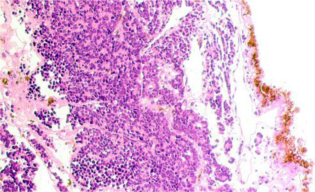 Figure 1 - Retina of a 9-year-old boy with retinoblastoma. Microphoto. Stained with hematoxylin and eosin. Magnification x100.