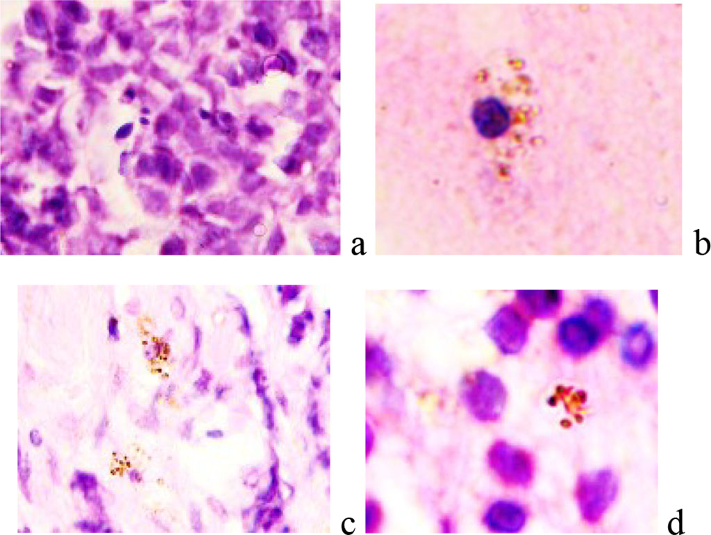 Figure 2 - Retina of a 9-year-old boy with retinoblastoma. Microphoto. Stained with hematoxylin and eosin. Magnification x400.