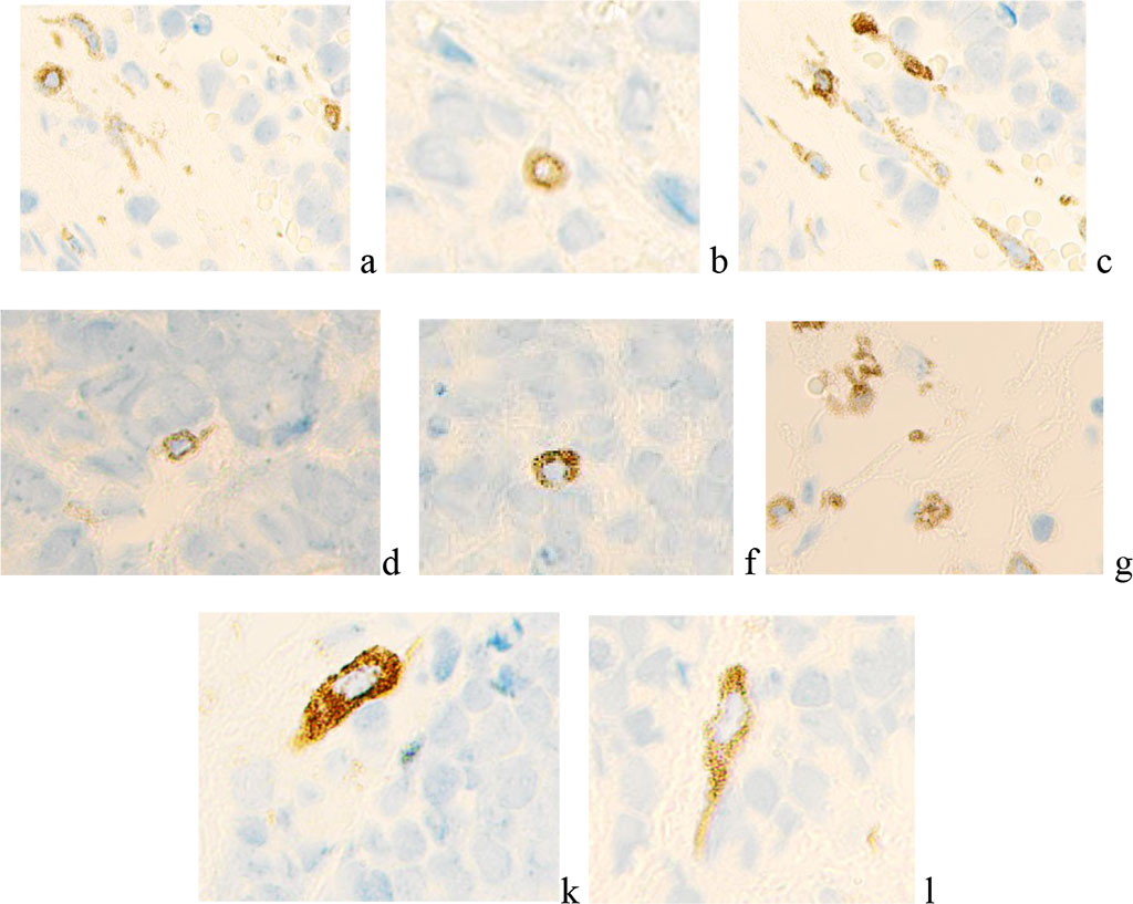Figure 3 - Microphoto. Immunohistochemistry to detect the localization of VEGF-positive cells. Nucleus staining with hematoxylin. Magnification x400.