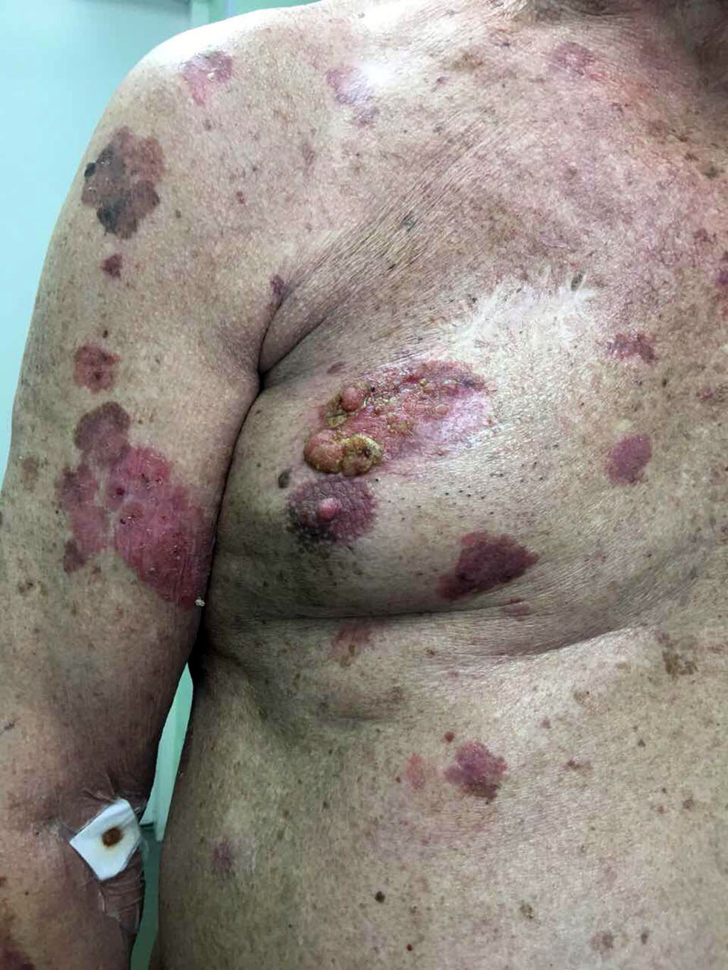 Figure 2. Spots, plaques, nodes on the skin of the right shoulder and chest 