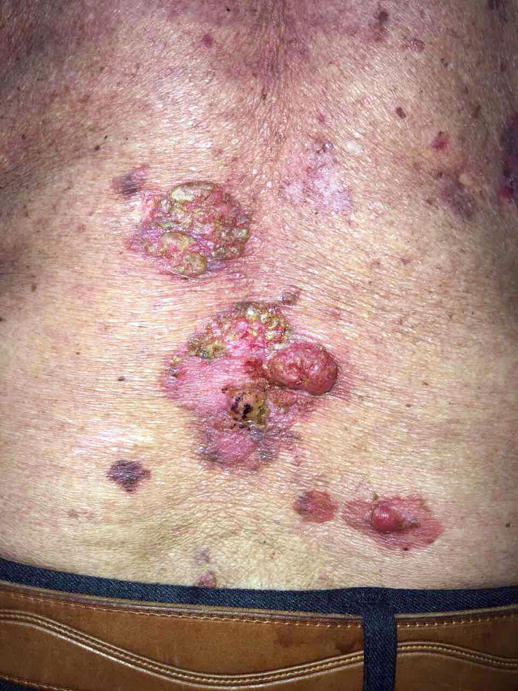 Figure 4. Spots, plaques, nodes on the skin of the lumbar 
