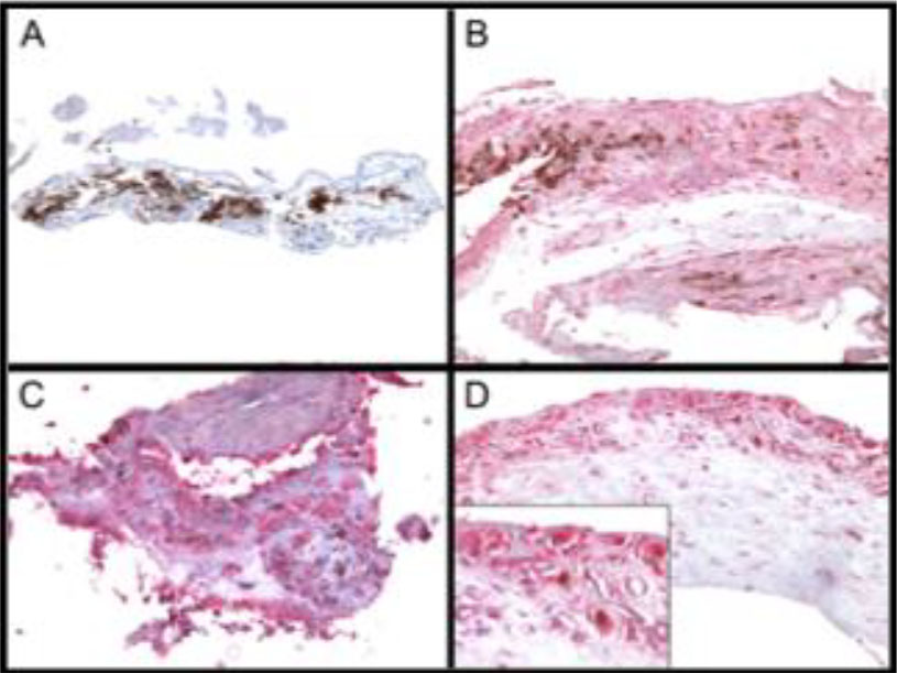 Figure 2. SIRT1 expression in choroidal neovascular membranes. A) Negative. B) Weak expression. C) Strong expression. D) Insert shows vascular endothelial cell staining. 
