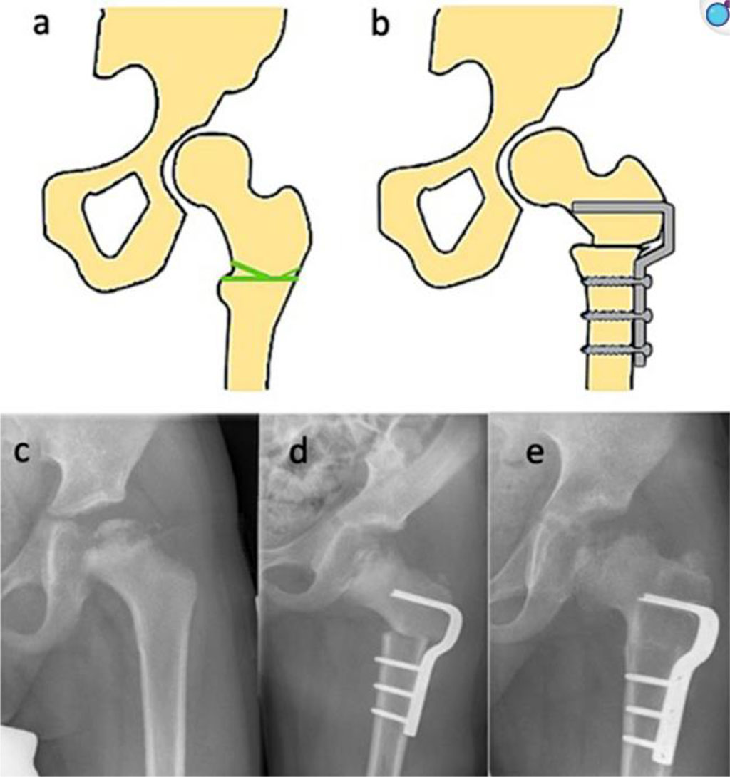 Fig. 3 Femoral varus osteotomy (FVO) [40].