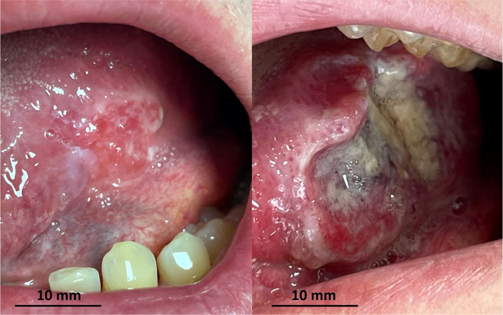 Fig. 2 2-month rapid progression of oral squamous cell carcinoma.