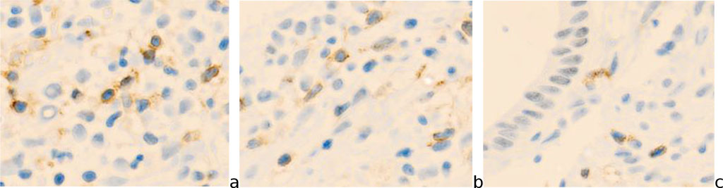 Fig.1- Cervix mucosa of a 54-year-old woman. A) exocervix (CD8); b) transformation zone (junction) (CD4); c) endocervix (CD8). Immune histochemistry to detect the localization of CD4 and CD8 with additional staining with hematoxylin. Microphoto. Zoom x 200.