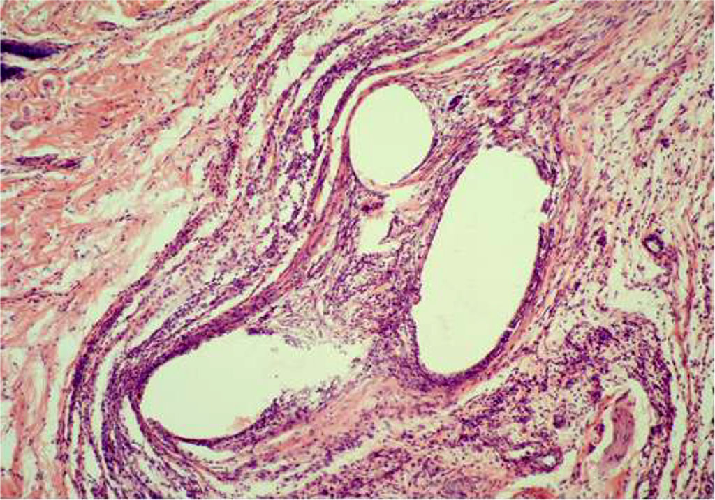 Fig. 2. AAW of the MG animal by Day 7 of the experiment. Staining with H&E. ×10 