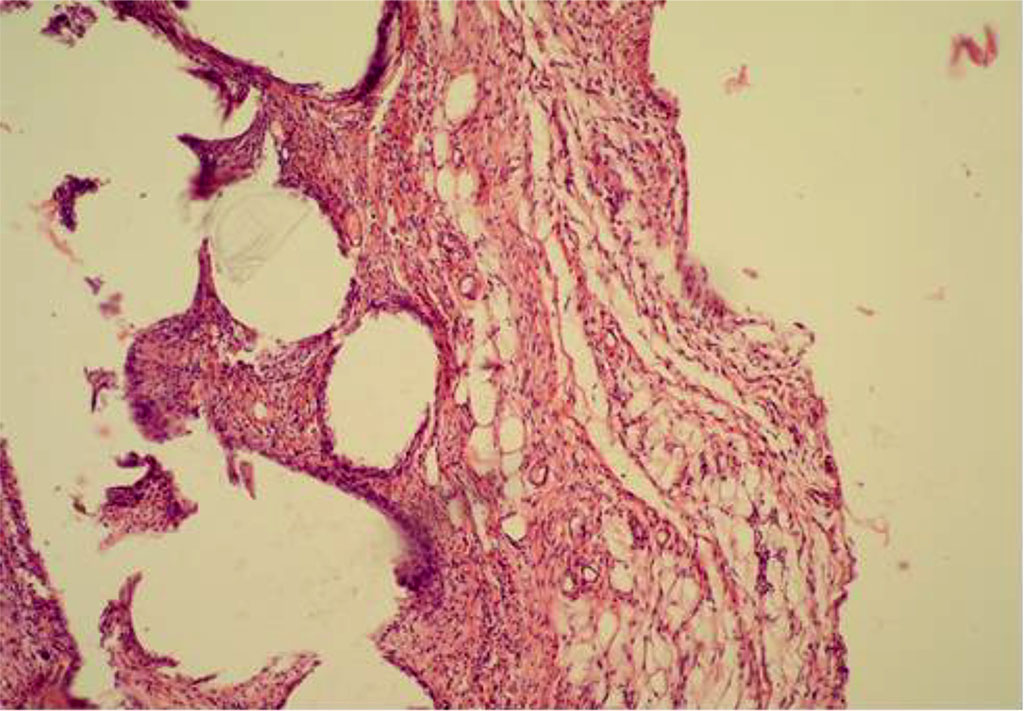 Fig. 4. AAW of the MG animal by Day 14 of the experiment. Staining with H&E. ×10 