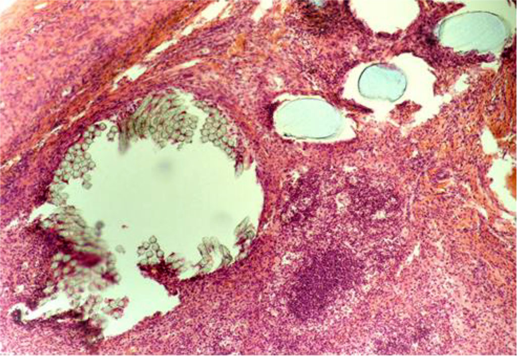 Fig. 5. The fragment of AAW of the CG animal with elements of PP-MI. Day 21 of the experiment. Staining with H&E. ×10 