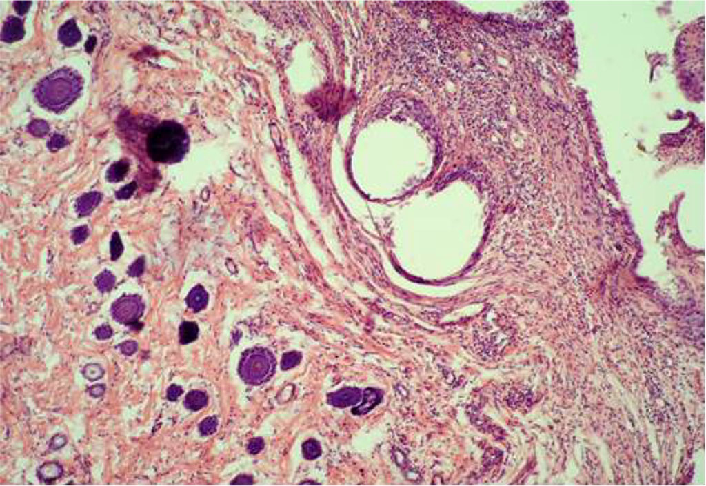 Fig. 6. The fragment of AAW of the MG animal with elements of PP-MI. Day 21 of the experiment. Staining with H&E. ×10 