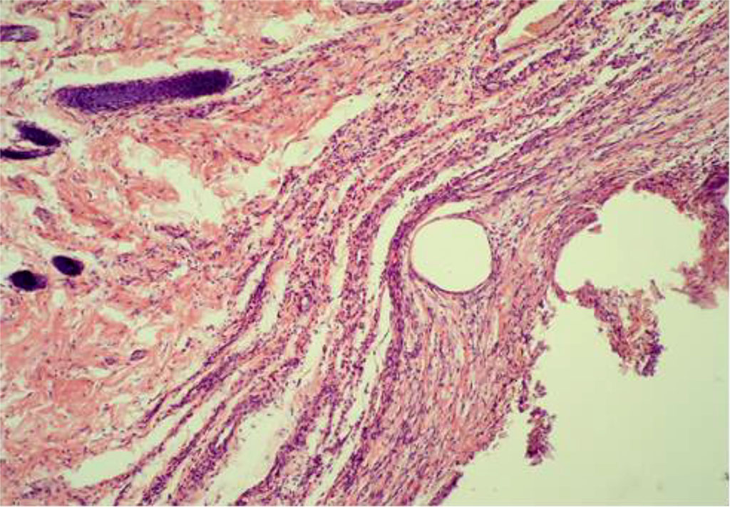 Fig. 8. The fragment of AAW of the MG animal with elements of PP-MI. Day 28 of the experiment. Staining with H&E. ×10 