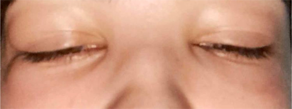 Figure 1. Periorbital edema of the patient.