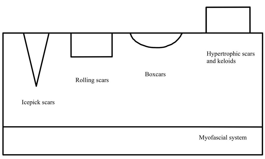 Figure 1. Types of acne scars depending on different depths.
