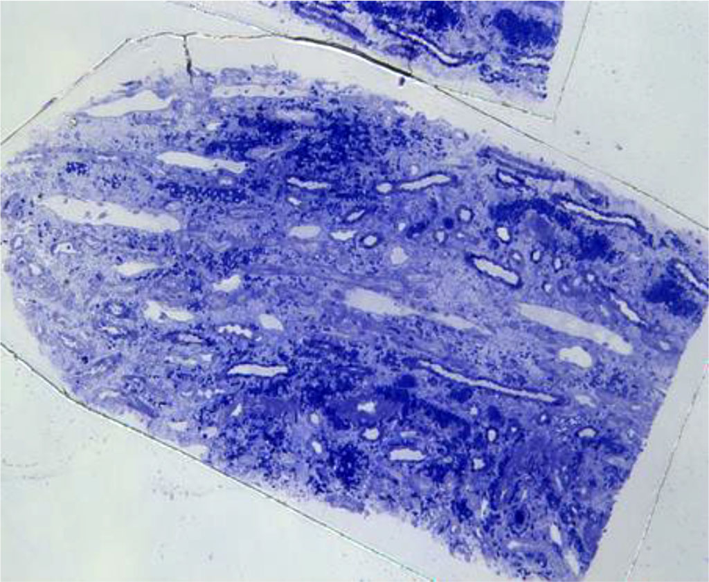 Figure. 1 Light microscopy- Severe interstitial hemorrhage in the medulla without interstitial inflammatory reaction