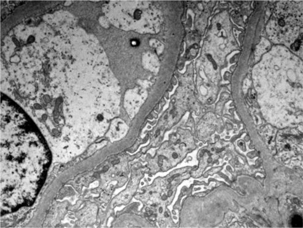 Figure 4. Electron microscopy - Podocytes foot process effacement