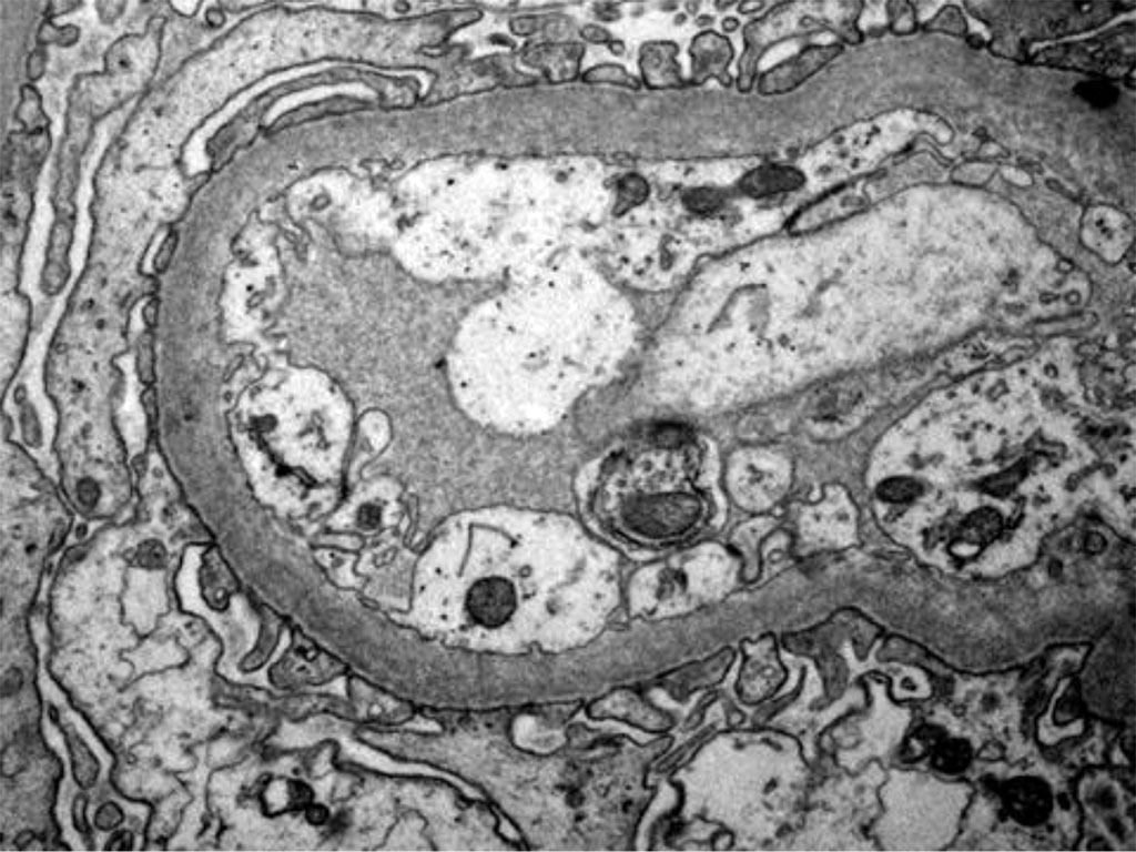 Figure 5. Electron microscopy - Podocytes foot process Effacement