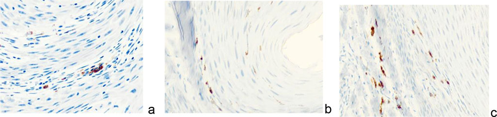 Figure 10 - Immunocytes CD in the structure of keloid scar in the auricle area of a 43- year-old man. Immunohistochemistry used to detect localization of immunocytes in the skin of the auricle. Magnification: a, b) х100; a, b, c) х 200