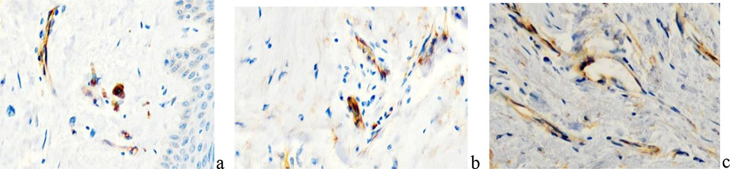 Figure 11 - Localization of cells expressing VEGF in the scar structure. immune histochemistry. Magnification a, b, c x200.