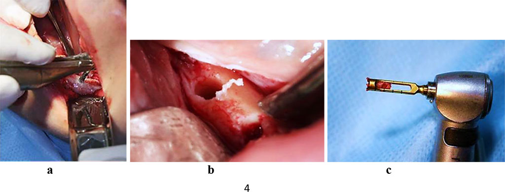 Figure 3. Bone biopsy sampling at the projection area of the dental implant, patient with a partial adentia (a, b), hollow milling cutter with bone biopsy obtained for histomorphological examination (c).