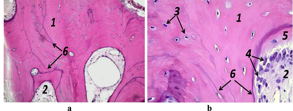 Figure 9. Histological preparation; patient K., 57 y.o.; hematoxylin-eosin staining; a – magnification (×250); b − magnification (×500); 1− bone trabeculae; 2 − red bone marrow; 3 – osteocytes; 4 – active osteoblasts, 5 – osteoid; 6 – bonding lines.
