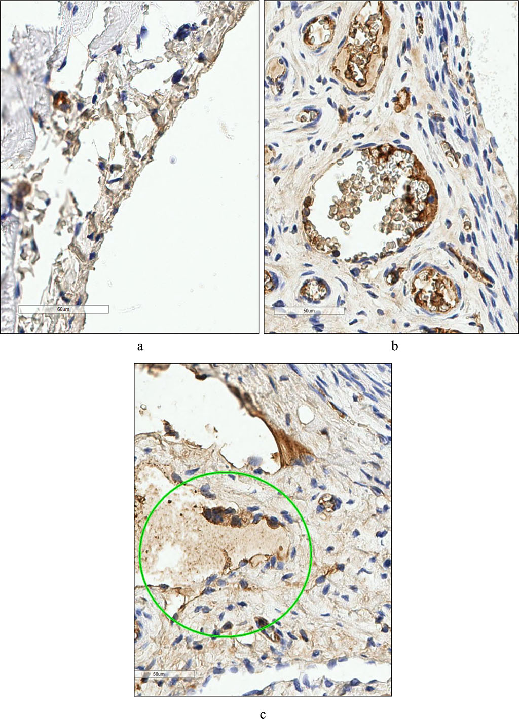 Fig. 2. Rat's peritoneum. Expression of the marker CD56+ a - in the control group, b - after surgery. Rat parametry. Expression of CD56+ c marker - post-treatment. (×400).
