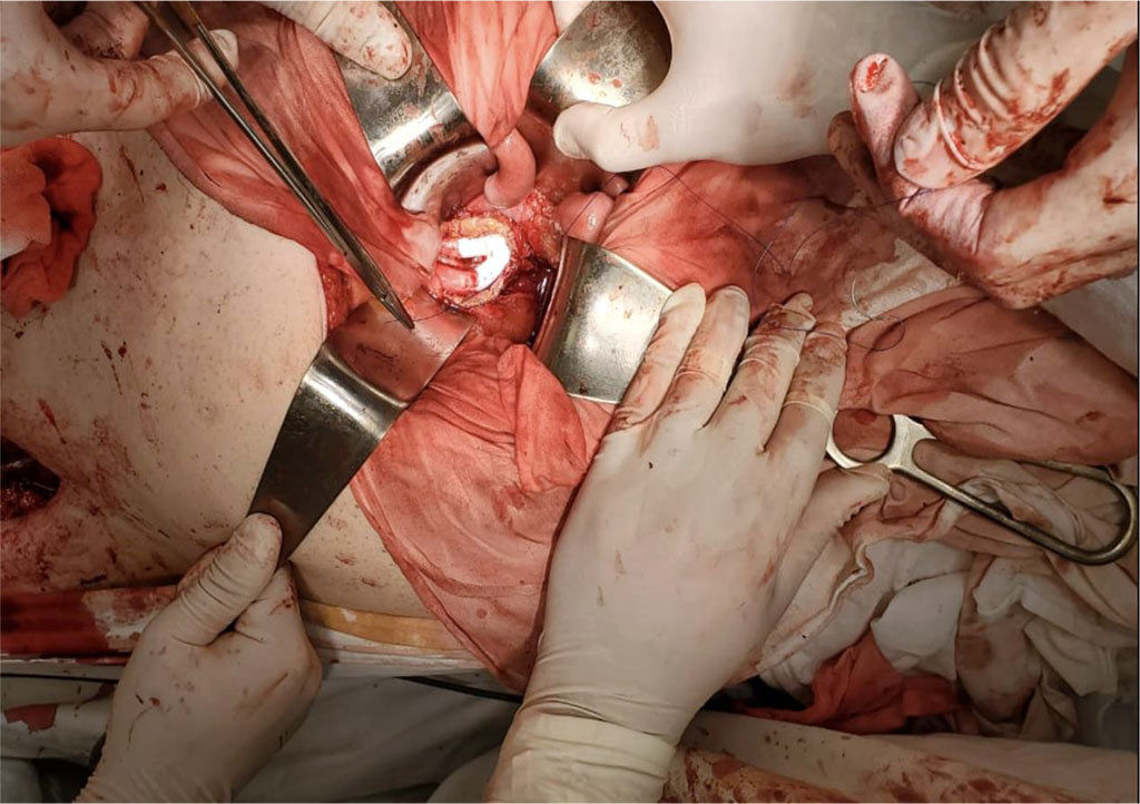 Figure 1. Formation of a proximal anastomosis - the end of the bifurcation prosthesis to the end of the aorta - through a mini-access in a patient with an aortic aneurysm 