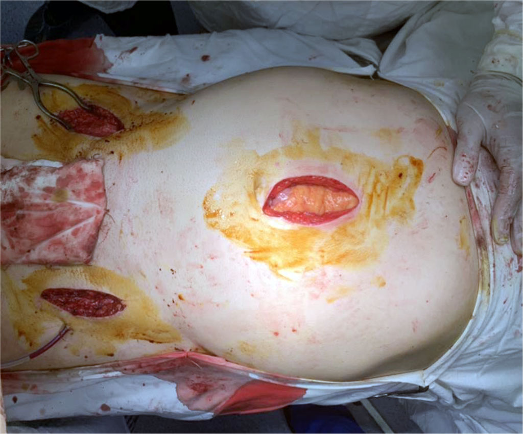 Figure 2. Completion of aortobifemoral alloshunting through a mini-access in a patient with Leriche syndrome 