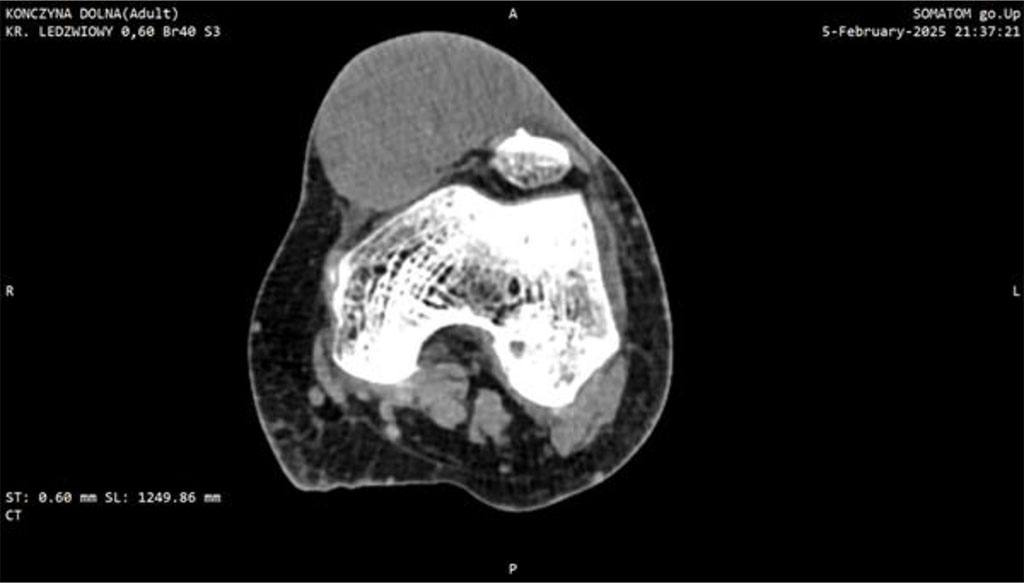 Figure 2: CT scan of the knee joint with Myxofibrosarcoma (MFS). Axial plane.