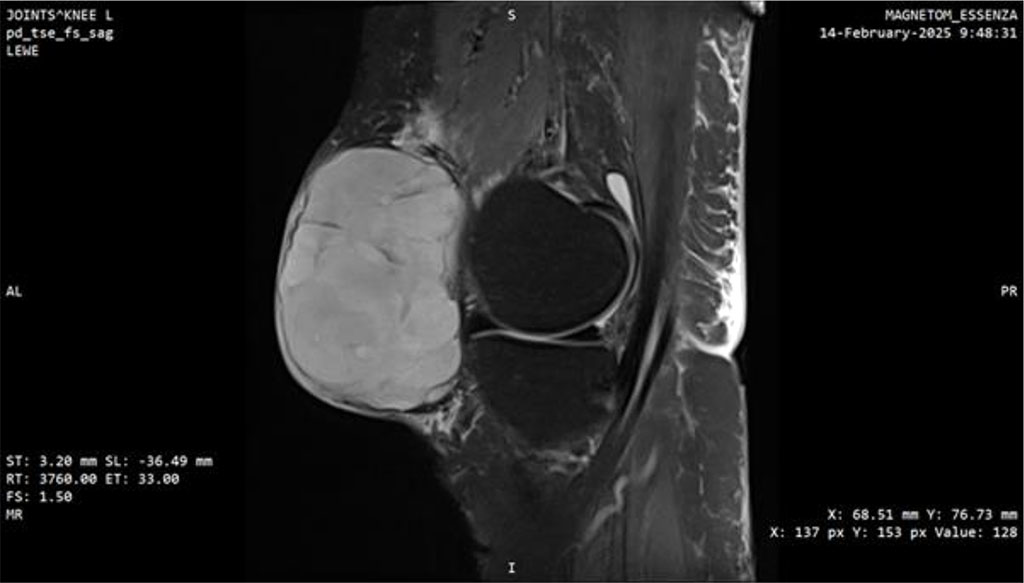 Figure 3: MRI scan of the knee joint with Myxofibrosarcoma (MFS). Sagittal plane.