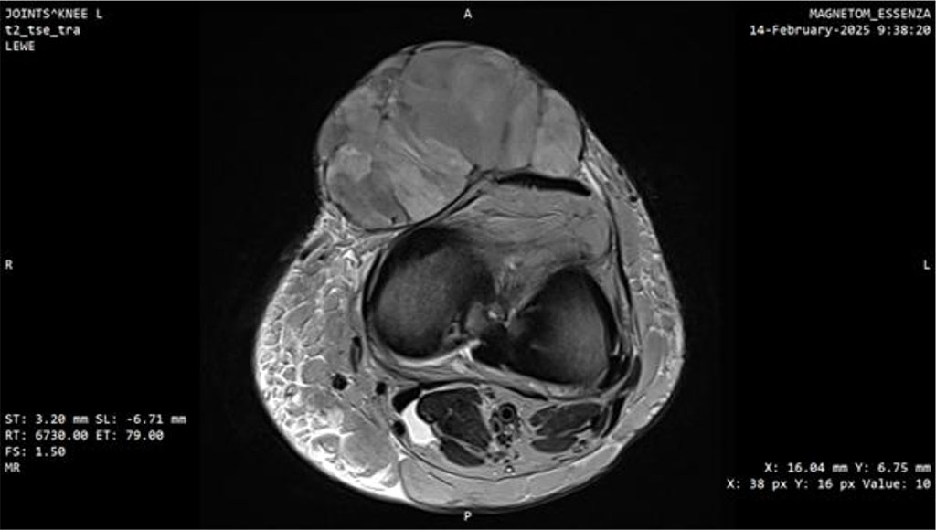 Figure 4: MRI scan of the knee joint with Myxofibrosarcoma (MFS). Axial plane.