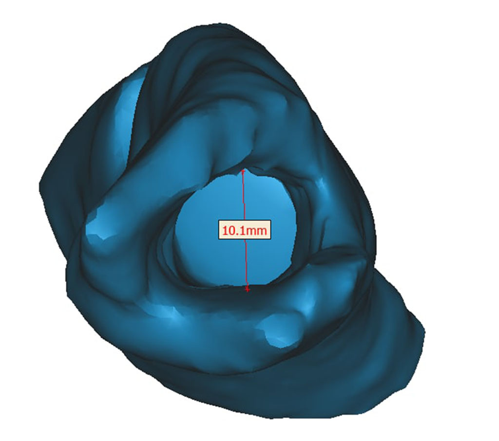 Photo 6. Virtual axial section of the medullary canal of the humerus using the MATERIALIZE MIMICS INNOVATION SUITE SOFTWARE.