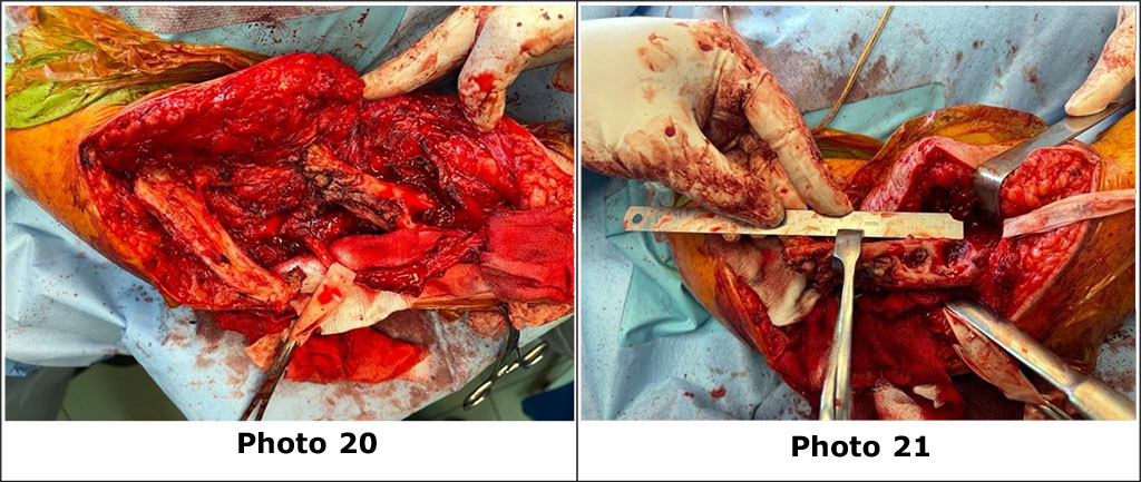 Photo 20. Bone fragments of the right humerus mobilized from scar tissue. Neurolysis of the right radial nerve was also performed.