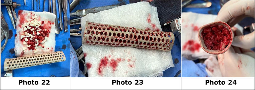 Photo 22. General view of the combined auto-alloplastic material and PEEK lattice.